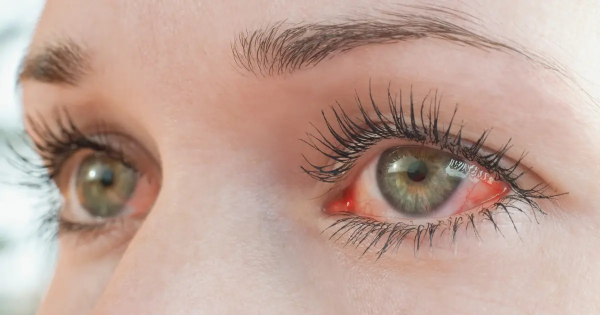 Eye Drops for Red Eyes, Eye Redness